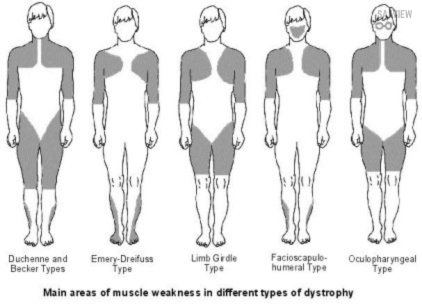muscular-weekness